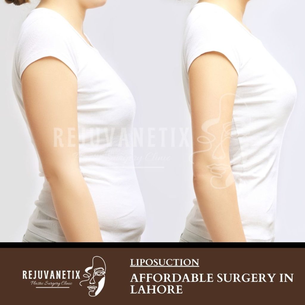 Affordable Liposuction Surgery in Lahore