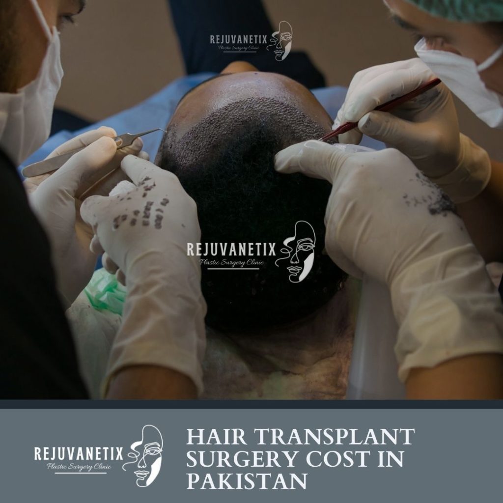 Hair Transplant Surgery Cost in Pakistan